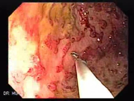 Multiple Rectal Ulcers (22 of 110)