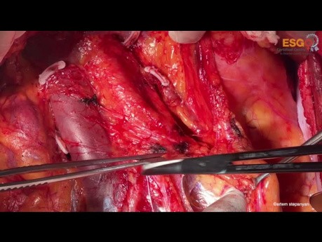 Open Para-Aortic Lymphadenectomy