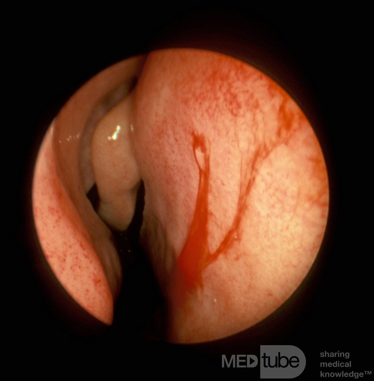 Large Blood Vessels Anterior Nasal Septum