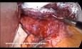 Laparoscopic Heller Myotomy EGJ Perforation Treated by Belsey Fat Pad Suturing