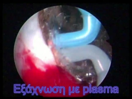TURis Plasma Vaporization