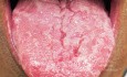 Geographic Tongue with Glossitis