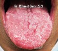 Geographic Tongue with Glossitis