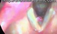 Videostroboscopy-True Vocal Fold Polyp 