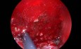 Adenoidectomy 