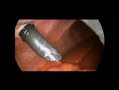 Laparoscopic Cholecystectomy in a Child with an Atypical Course of Cystic Artery