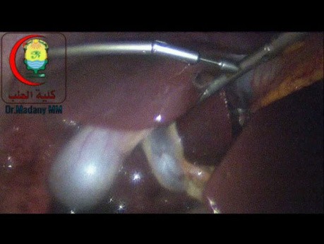 Manipulating and Properly Placing the Liver Retractor is Essential for Exposure of the Field to Deal with Cysts on the Undersurface of the Liver