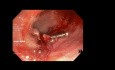 Colonic Polypectomy with Clipping