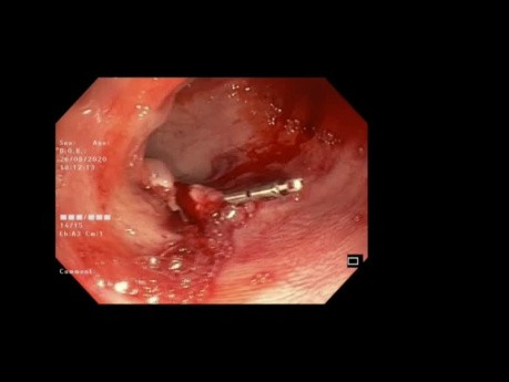 Colonic Polypectomy with Clipping