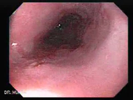 Endoscopic view of Barrett Esophagus residual island of Barrett's tongues (9 of 9)