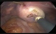 12 x 9 x 8 cm Right Ovarian Cyst With 3 Twist Torsion