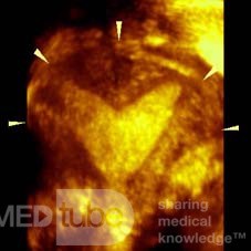 SUBSEPTATE UTERUS BY THREE DIMENSION ULTRASOUND