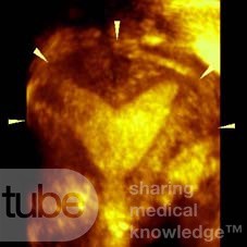 SUBSEPTATE UTERUS BY THREE DIMENSION ULTRASOUND