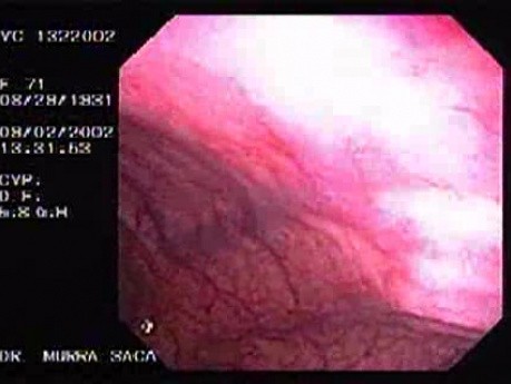 Rectal Varix (1 of 2)
