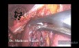 Laparoscopic Cholecystectomy in Contracted Gallbladder