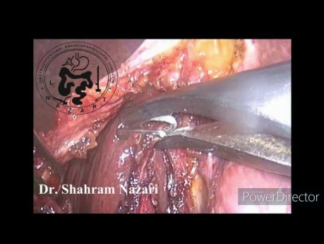 Laparoscopic Cholecystectomy in Contracted Gallbladder
