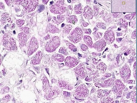 Mycobacterium avium-intracellula