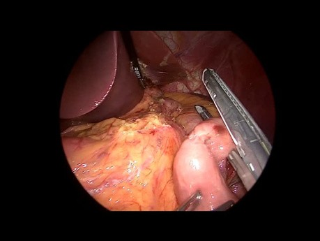 Gastric Sleeve to RY Gastric Bypass Conversion