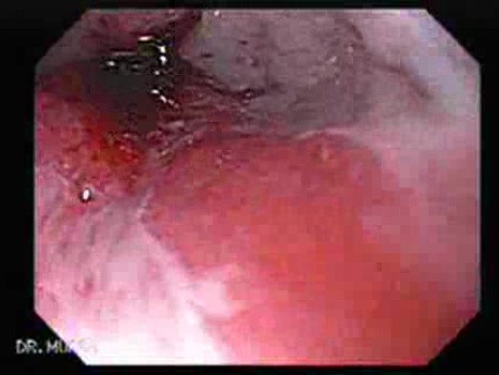Magnification Endoscopy of Barrett's Tongue, Part 1