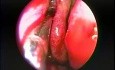Intranasal Maxillary Sinus Antrostomy - Endoscopy