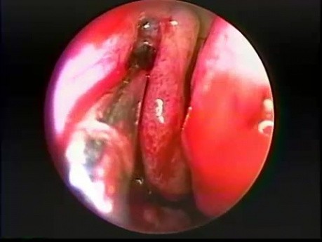 Intranasal Maxillary Sinus Antrostomy - Endoscopy