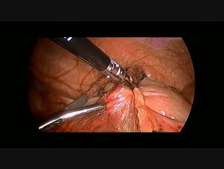 Laparoscopic Appendectomy