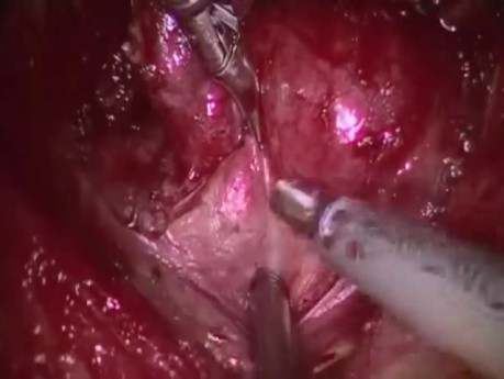Robot-Assisted Transaxillary Right Thyroid Lobectomy