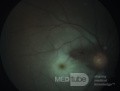 Central Retinal Artery Occlusion with Cilio Retinal Branch Sparing