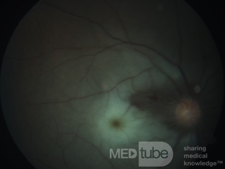 Central Retinal Artery Occlusion with Cilio Retinal Branch Sparing
