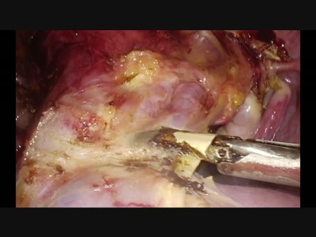 Day Care Hysterectomy