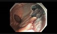 Colonoscopy - Rectum - Laterally Spreading Granular Tumor - EMR Part IV