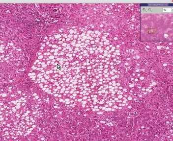 Alcoholic Liver Disease