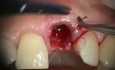 Immediate Implant, Provisional, Papilla And Fenestration Repair