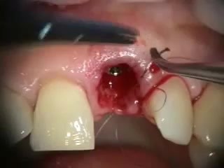 Immediate Implant, Provisional, Papilla And Fenestration Repair