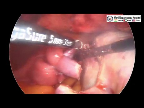 Laparoscopic Surgery for Torsion of Ovarian Cyst