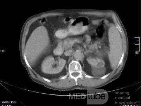 Gastrointestinal Stromal tumor (GIST) (9 of 13)