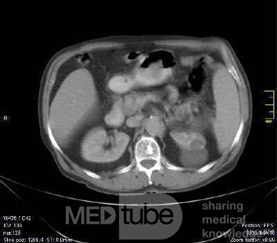 Gastrointestinal Stromal tumor (GIST) (9 of 13)