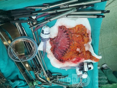 Laparoscopic Radical Subtotal Gastrectomy 