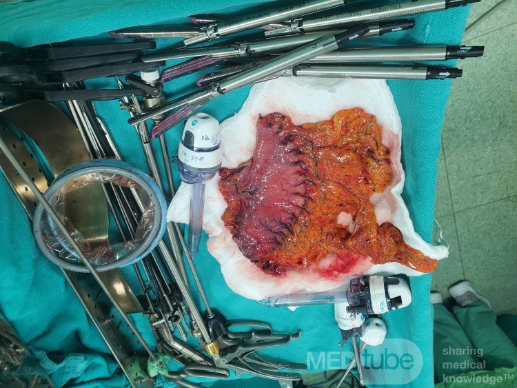 Laparoscopic Radical Subtotal Gastrectomy 