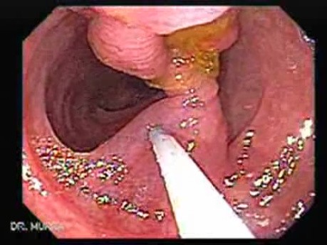 Colonoscopic Polypectomy (5 of 18)