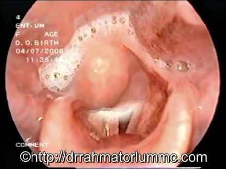 Pooling of Saliva in Hypopharynx