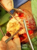 Epicranial Tumor Injury