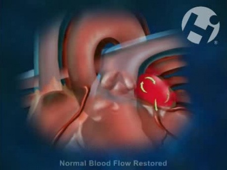 Atrial Fibrillation