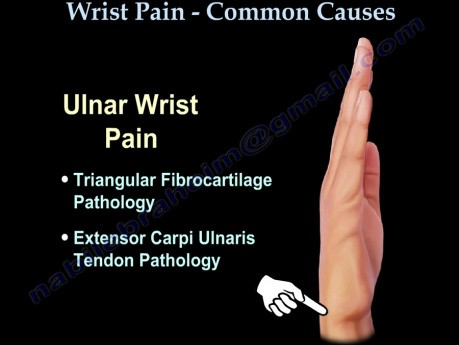 Causes of the Wrist Pain - Video Lecture