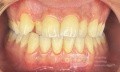 Orthodontic Case, What Treatment Plan?