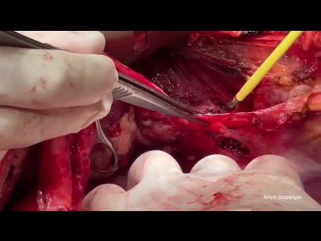 The Technical Aspects of Upper Abdominal Procedures in Advanced Ovarian Cancer Surgery