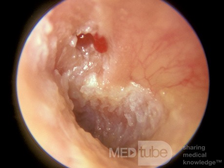Attic Cholesteatoma