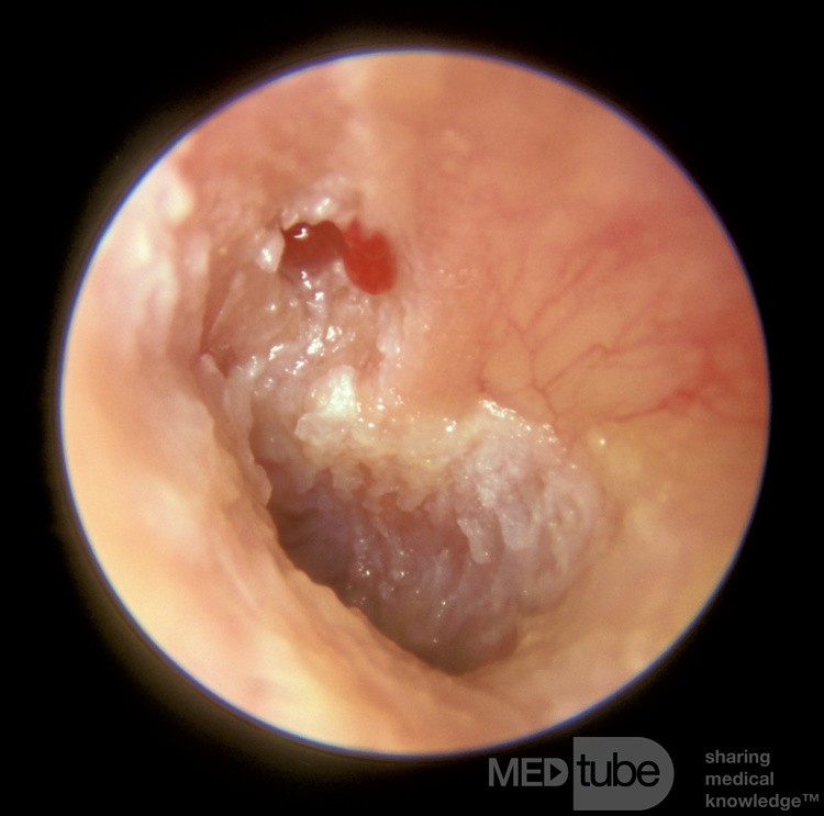 Attic Cholesteatoma