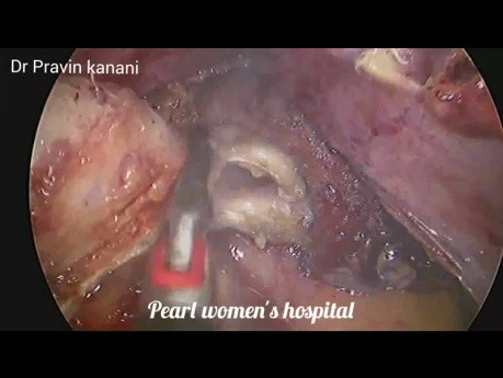 Laproscopic Repair of a Colovesical Fistula