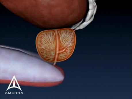 Prostate Biopsy - 3D Medical Animation 